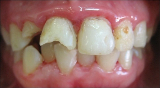 Enamel Infarctions Oral and Dental Injuries | Sports dentistry - Education and Prevention ...