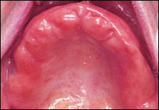 image showing erythamatous palatal mucosa