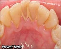 Tartar on Teeth - Vietnamese - Image2