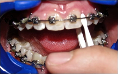 Image: Flossing the interproximal area.