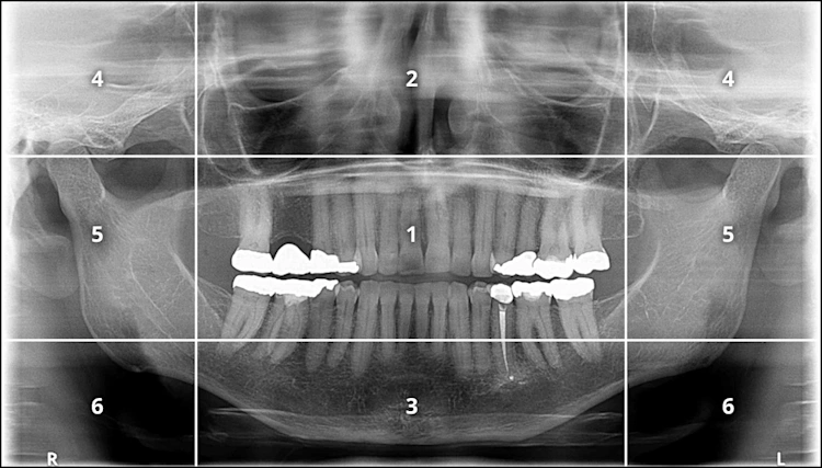 Introduction - Panoramic Radiographs: Technique & Anatomy Review ...