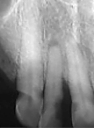 Periapical radiograph of #6 with toothbrush abrasion