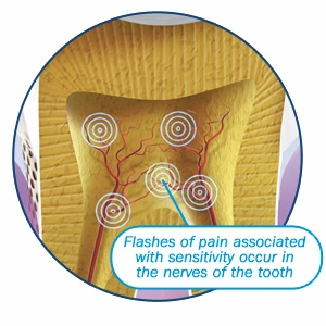 Image: Origin of pain associated with sensitive teeth.