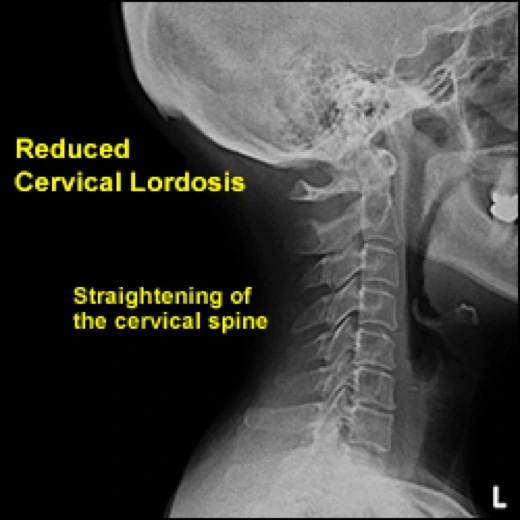 Image of reduced cervical lordosis.