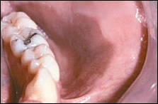 enlarged lesion