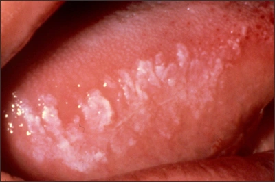 Photo showing an example of leukoplakia