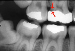 Secondary or Recurrent Caries