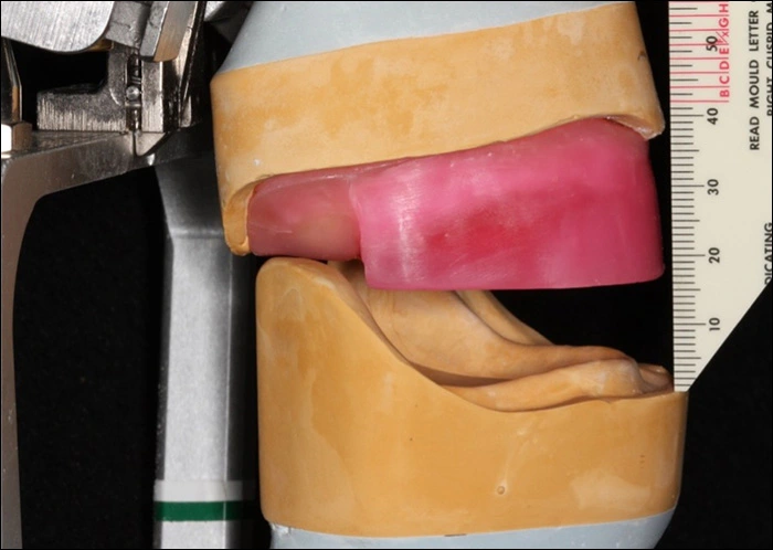 Photo showing the evaluation of restorative space using wax rims on mounted casts