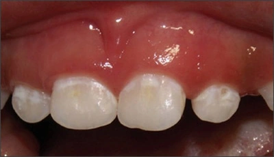 Image: Initial white decalcification of the anterior teeth.