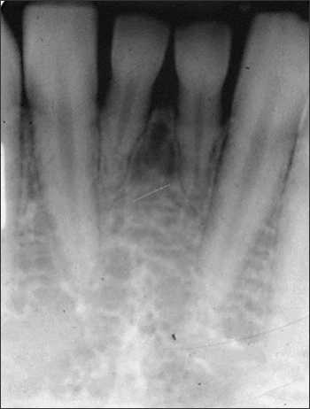 Alterations in the Number of Teeth - Figure 2