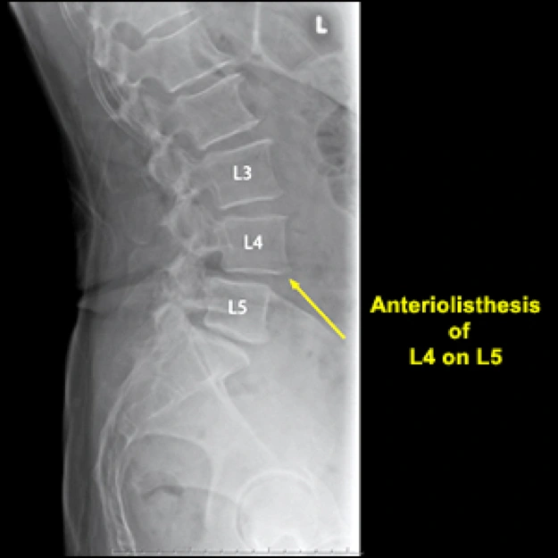 Image of anteriolisthesis.