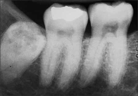 External resorption of impacted molar tooth #32