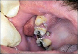 Image: Periodontal abscess