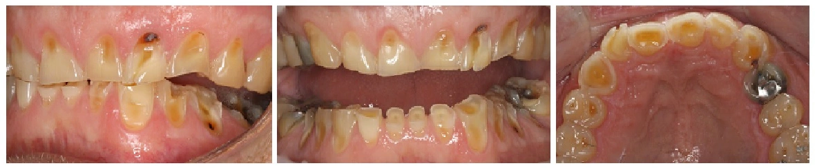 Photos showing severe erosion on a patient consuming 1.5 gallons of Kambucha fermented drink daily.