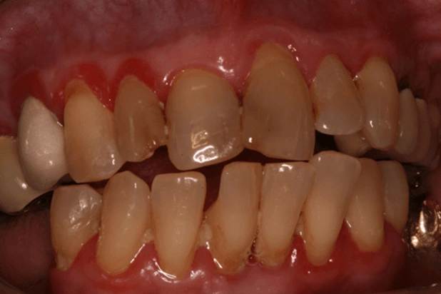 Photo showing recognizable signs of established gingivitis include red, edematous, bleeding gums.