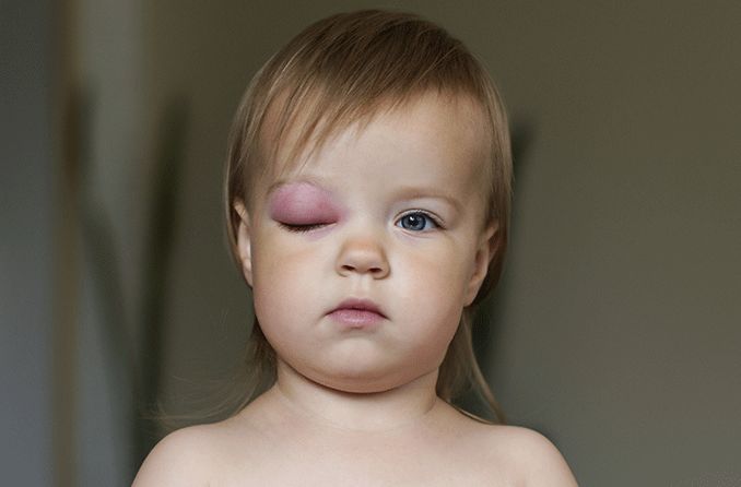 child with one swollen eyelid called periorbital cellulitis