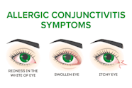 Allergic Conjunctivitis Discharge