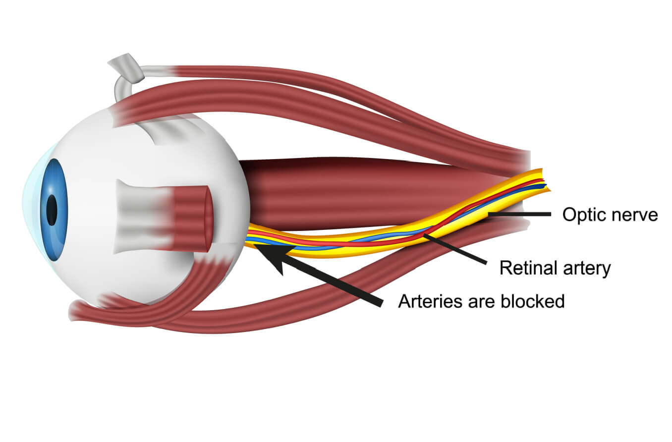 Ischemic optic neuropathy (ION) is a condition in which blood flow to the optic nerve is interrupted, which can lead to a loss of vision.