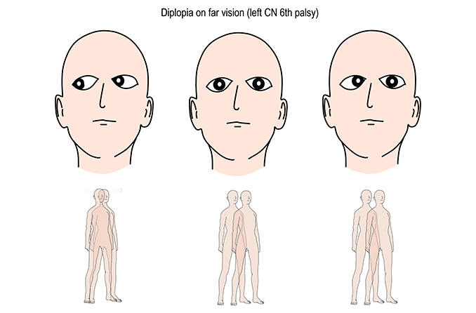 Sixth Nerve Palsy   Sixth Nerve Palsy 678x446 