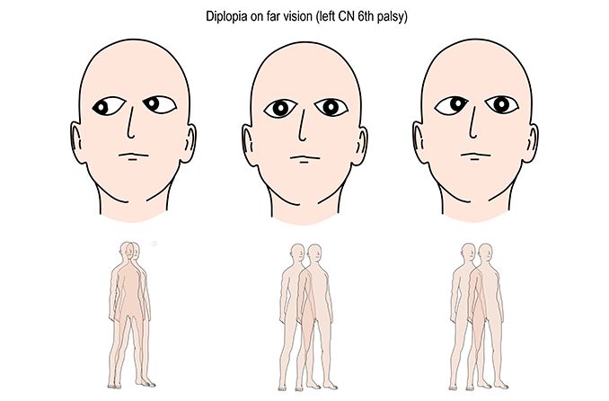 illustration of eyes with sixth nerve palsy which causes double vision