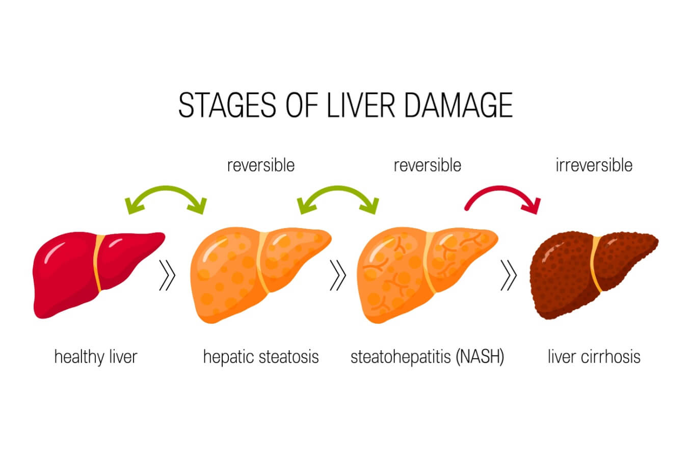 Diagram showcases the stages of liver damage.