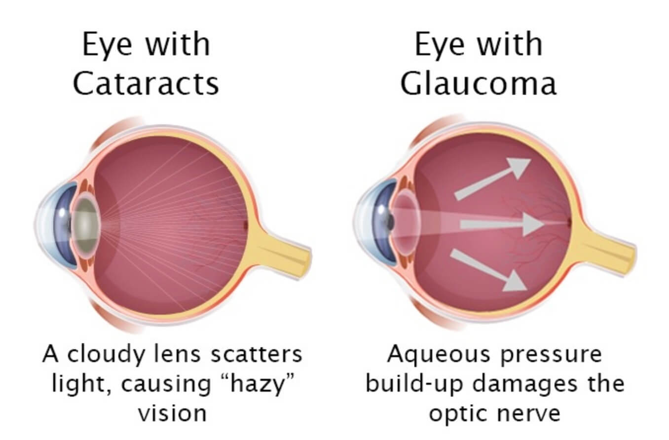 Cataract Surgery Articles