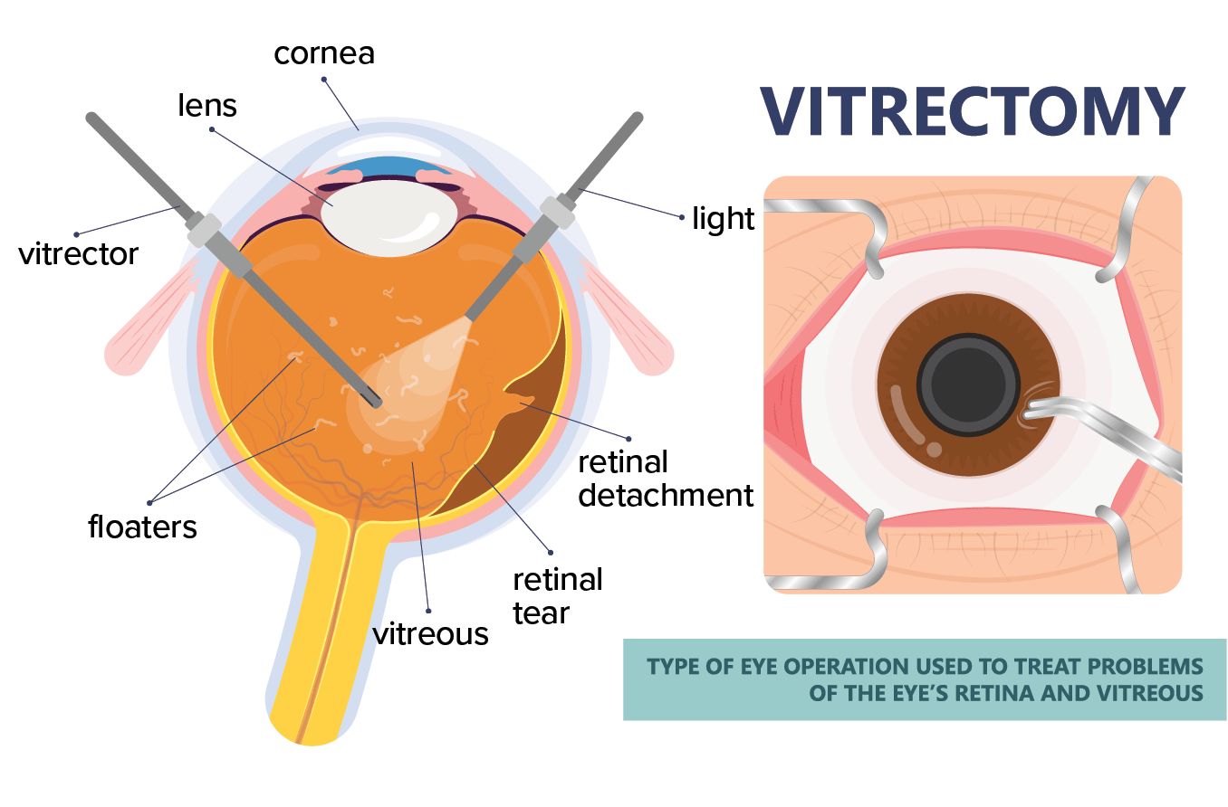 illustration of a vitrectomy (a type of retinal detachment surgery)