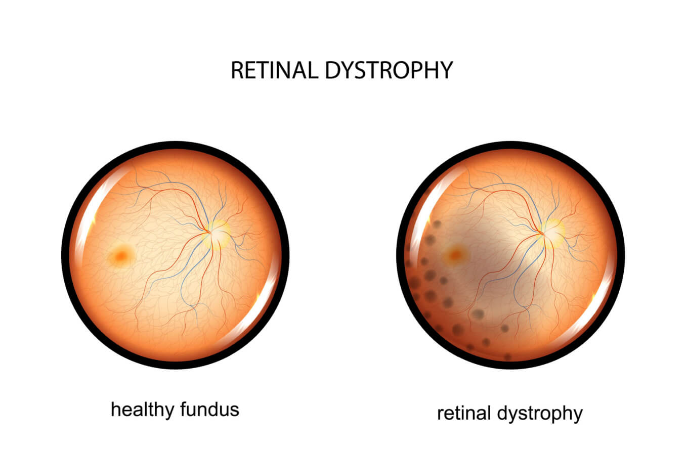 Illustration of the fundus and retinal dystrophy
