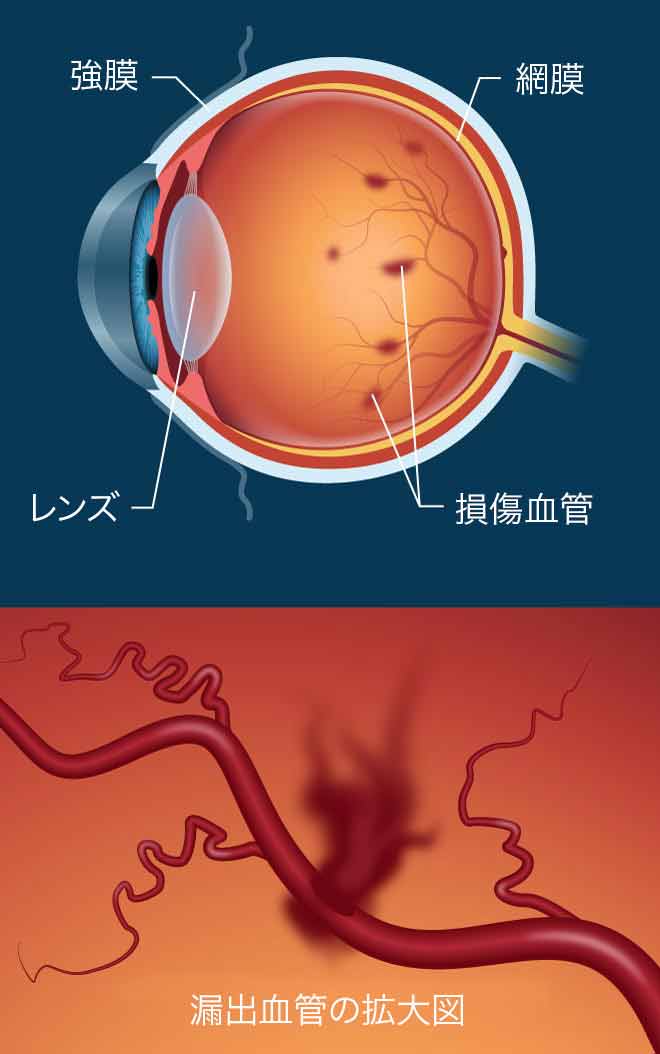 糖尿病網膜症：糖尿病による視覚障害