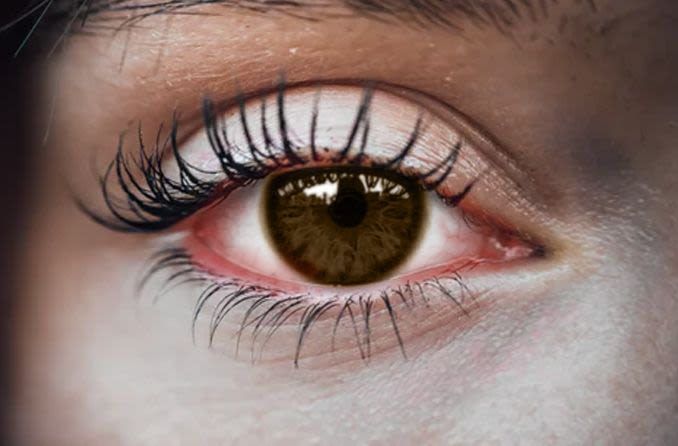 Femme souffrant des effets de l'oeil rose