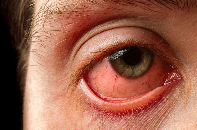 primer plano del ojo de un hombre que muestra síntomas de conjuntivitis (ojo rosado) de un ojo rojo e hinchado