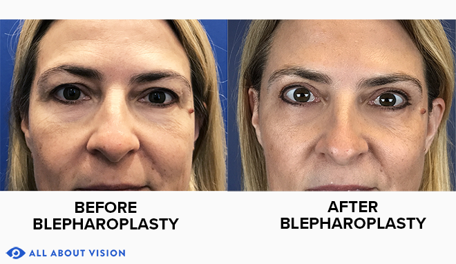 Toronto Blepharoplasty (Eyelid Surgery) | TPS