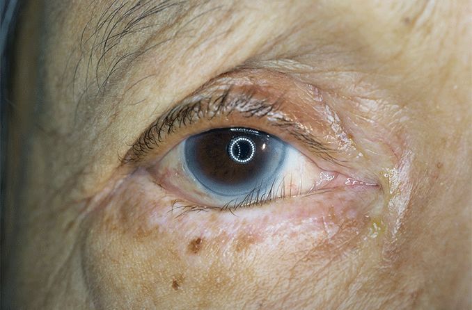 closeup of an elderly person's eye with entropian