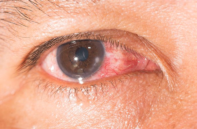 closeup of an eye with keratitis