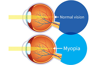 myopia視力矯正