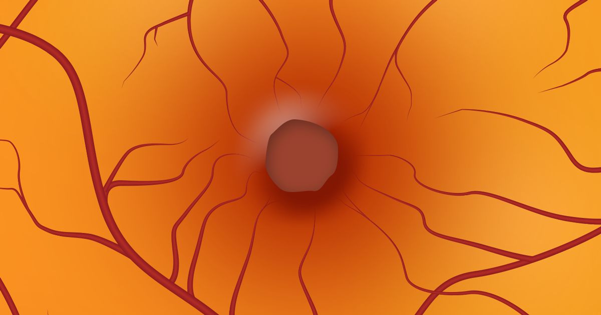 Illustration of a macular hole