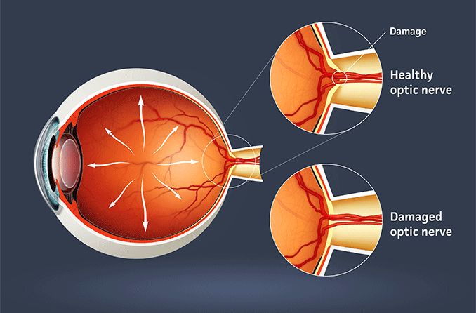 illustration of a healthy optic nerve vs a damaged optic nerve