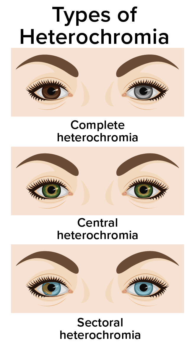 https://cdn.allaboutvision.com/heterochromia-types-660x1185.gif