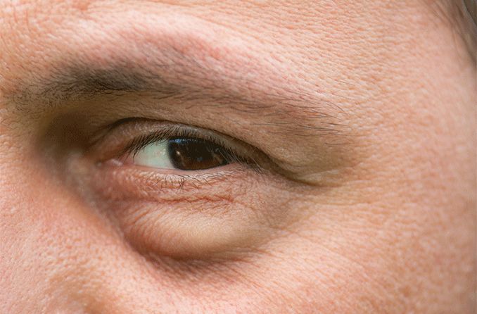 Eye muscle repair - series—Procedure: MedlinePlus Medical Encyclopedia