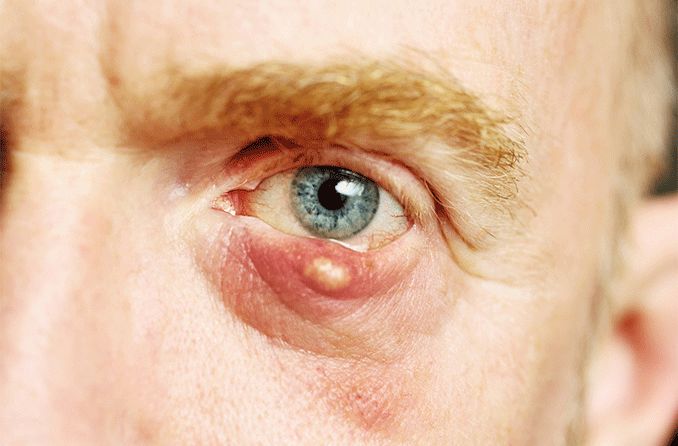 man with an eyelid cyst