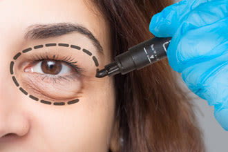Eyelid surgery: Options for improving appearance - All About Vision