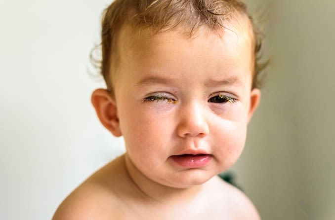Young toddler with swollen, crusted eyes from conjunctivitis