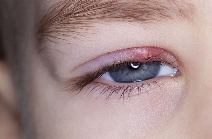 boy with a stye