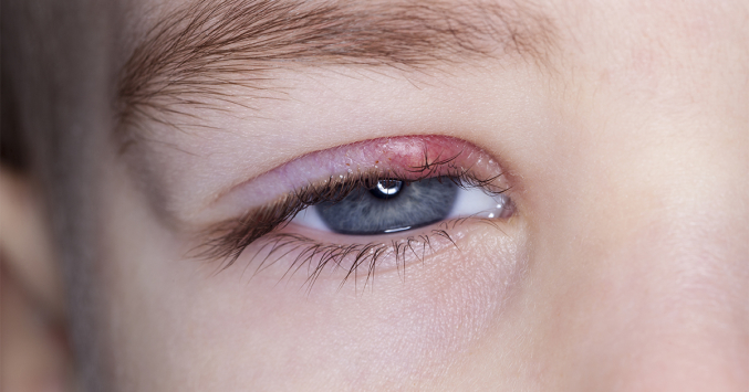 how-to-get-rid-of-a-stye-2-easy-treatments