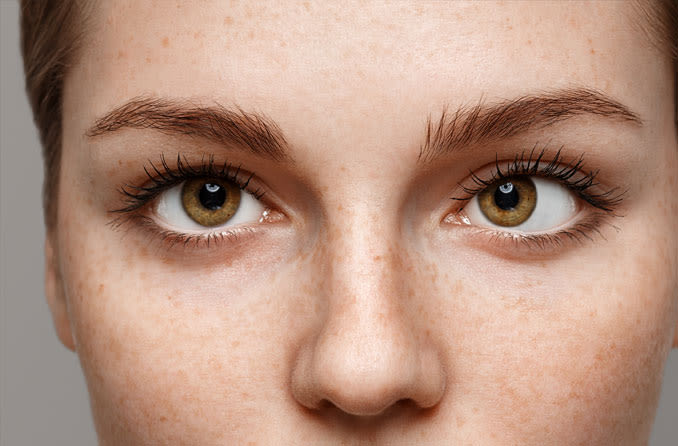 Mulher ruiva, com olhos castanhos e sardas com condição de estrabismo.