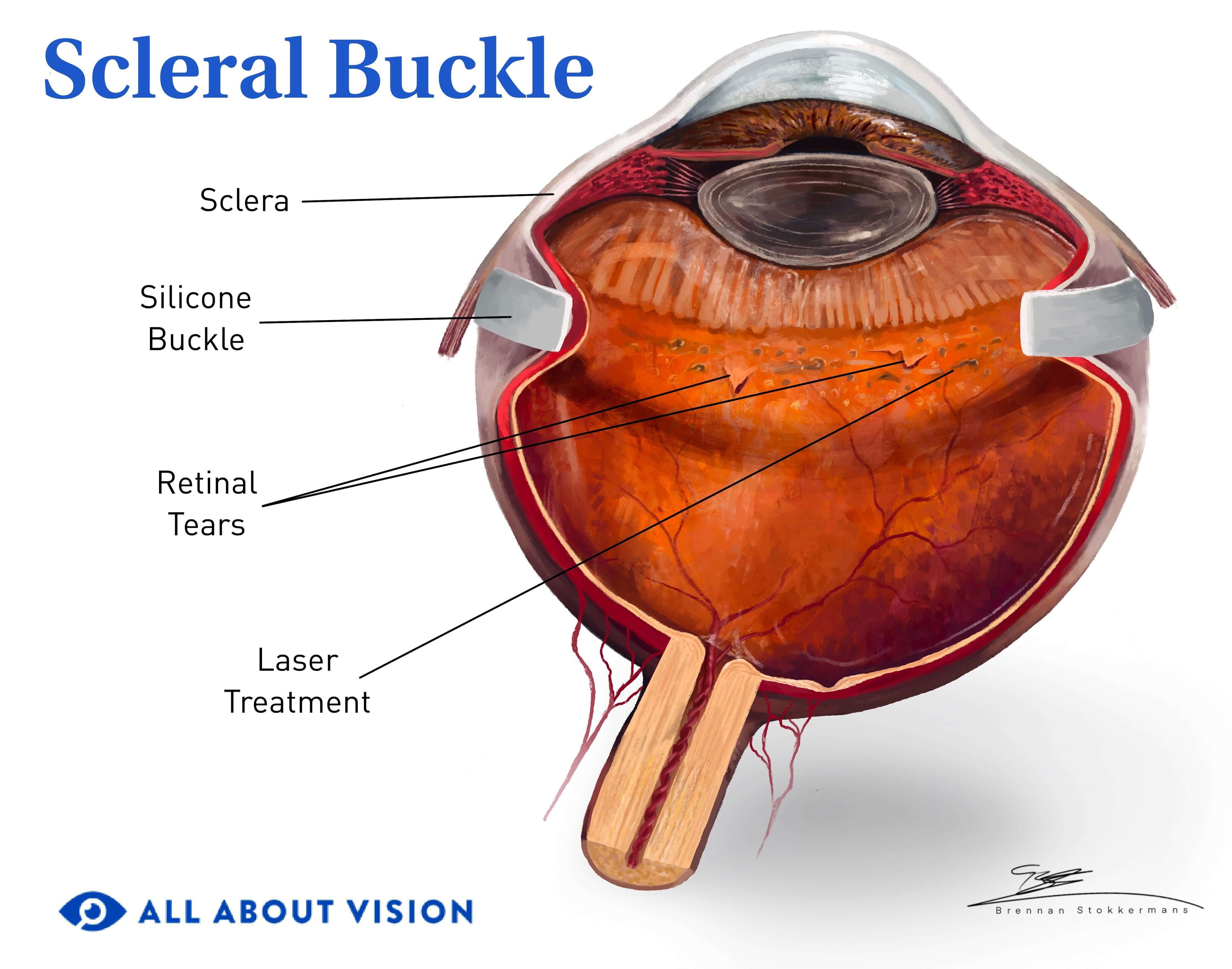 Scleral Buckle Surgery: Everything You Need to Know