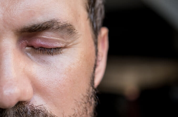 Swollen stye on man's eye