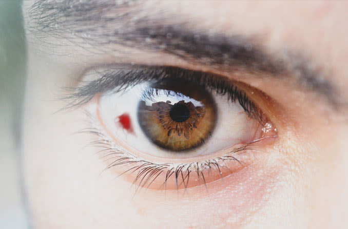 man with eye haemorrhage