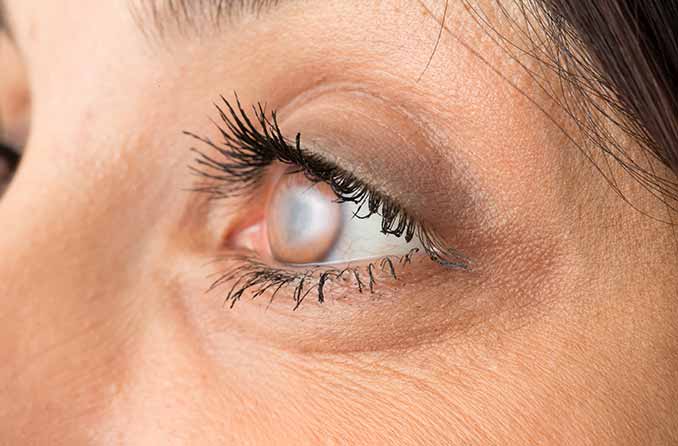 A nurse applying cataract eye drops