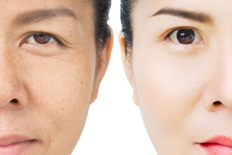 Eyelid Surgery Options For Improving Appearance All About